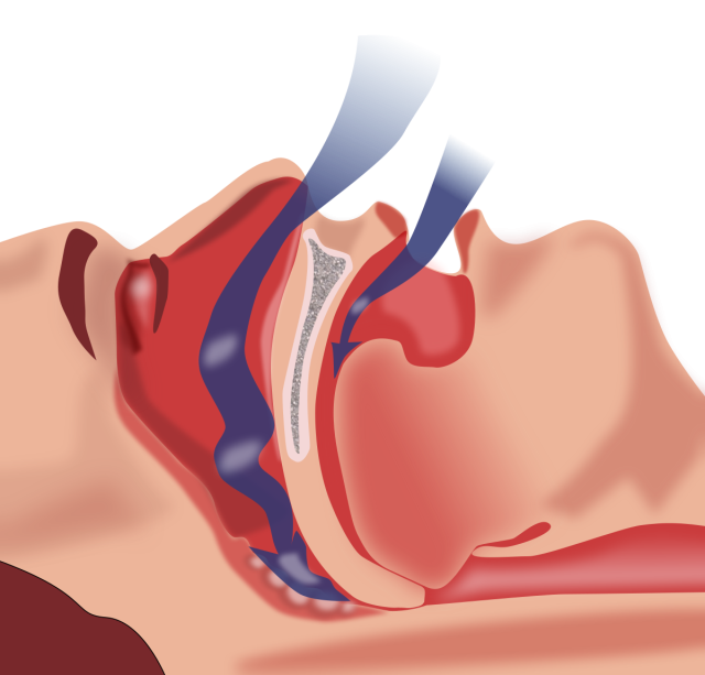 1200px Obstruction ventilation apnee sommeil.svg